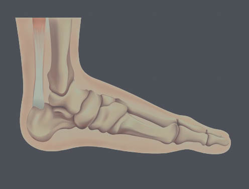 Peesblessures (algemeen)